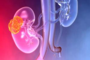 Ρομποτική Μερική Νεφρεκτομή