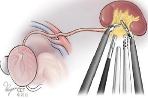 Ρομποτική Ριζική Νεφρεκτομή