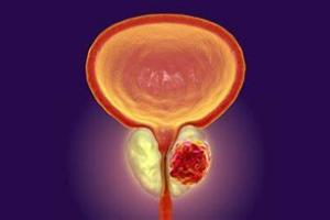 Ρομποτική Ριζική Προστατεκτομή