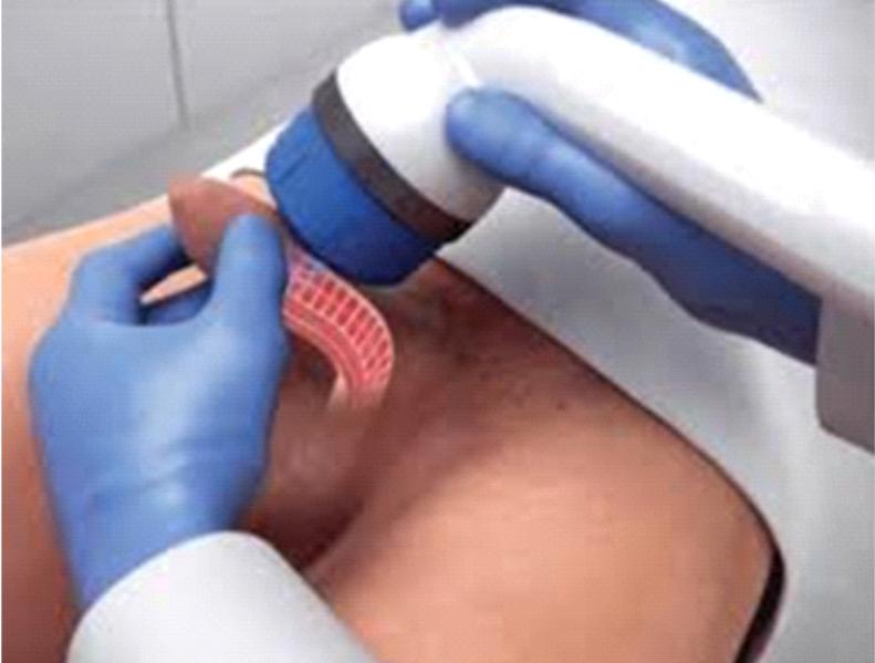 Θεραπεία με κρουστικά κύματα χαμηλής έντασης Li-ESWT