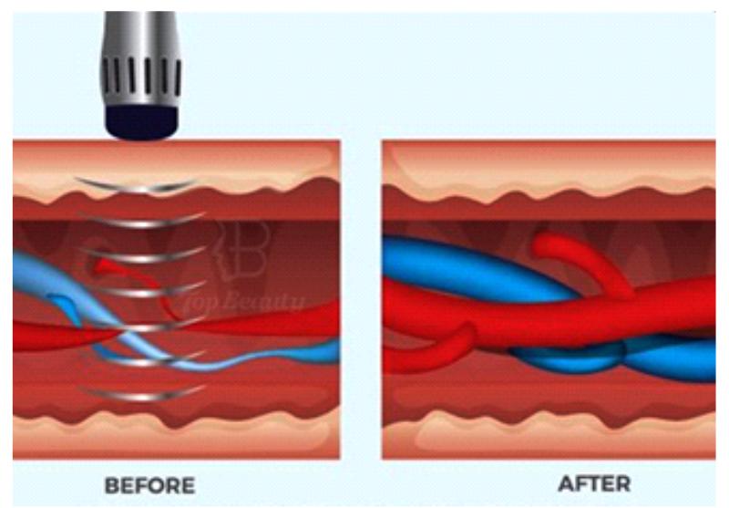 Πώς δρα η θεραπεία με κρουστικά κύματα
