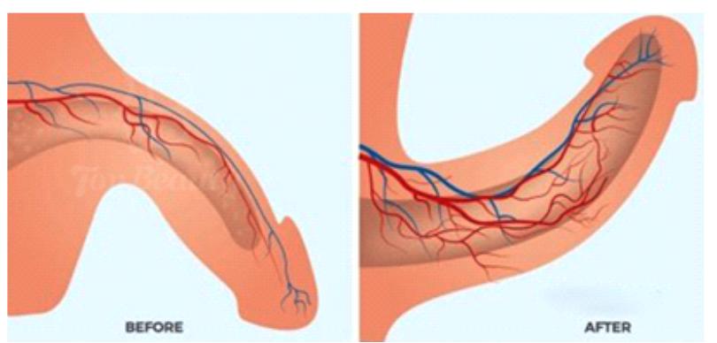 Στυτική Δυσλειτουργία